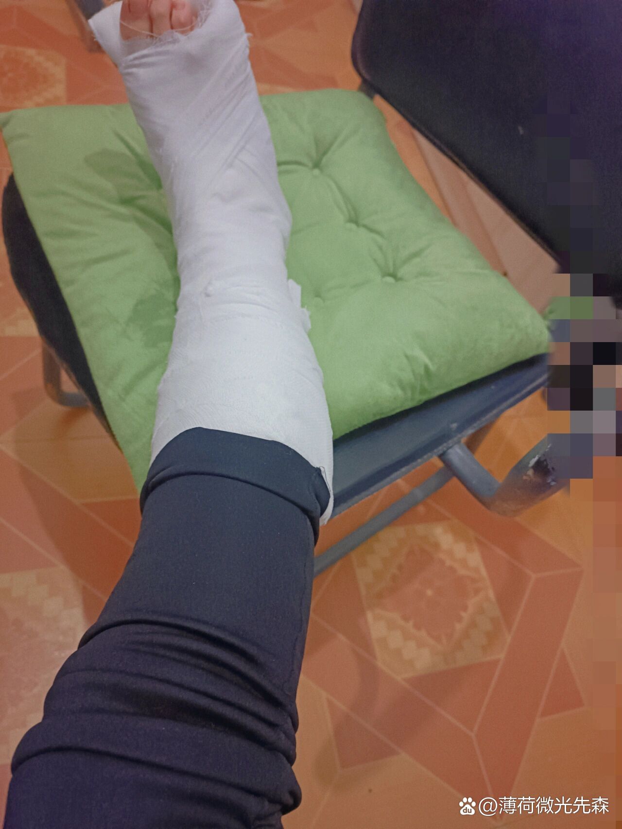 崴脚十八天后,打上了石膏没有比我再心大的吧.