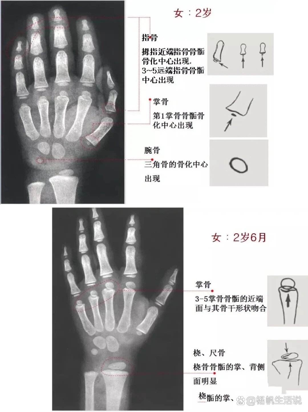 女童骨龄图谱