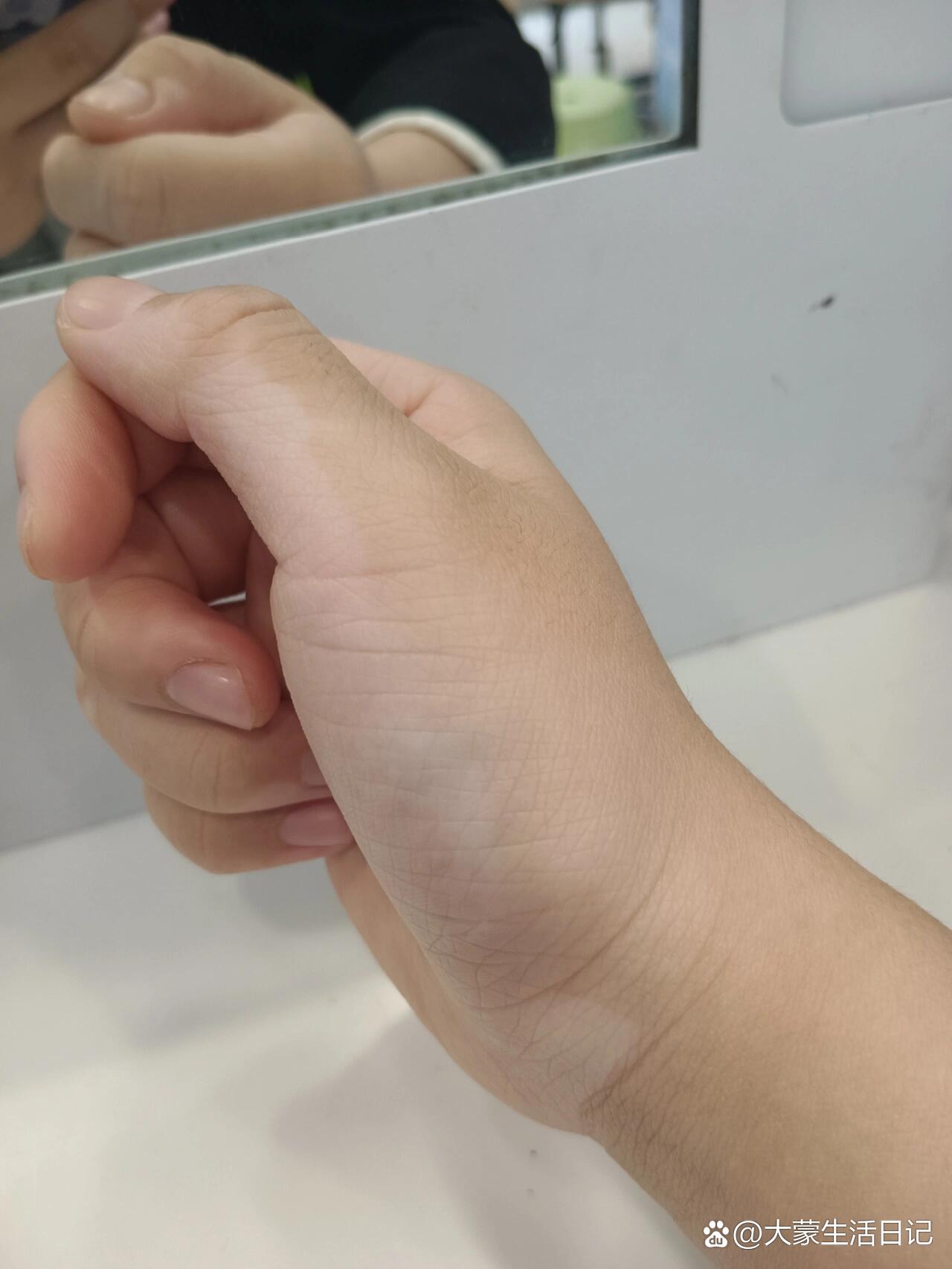 朋友们,手上的白癫疯怎么能治呀,我白癫疯17年就有了起初是眼睛上方长