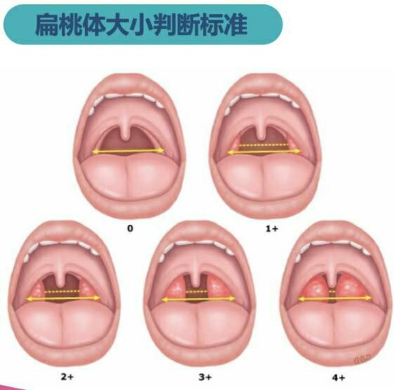 扁桃体肥大的原因图片