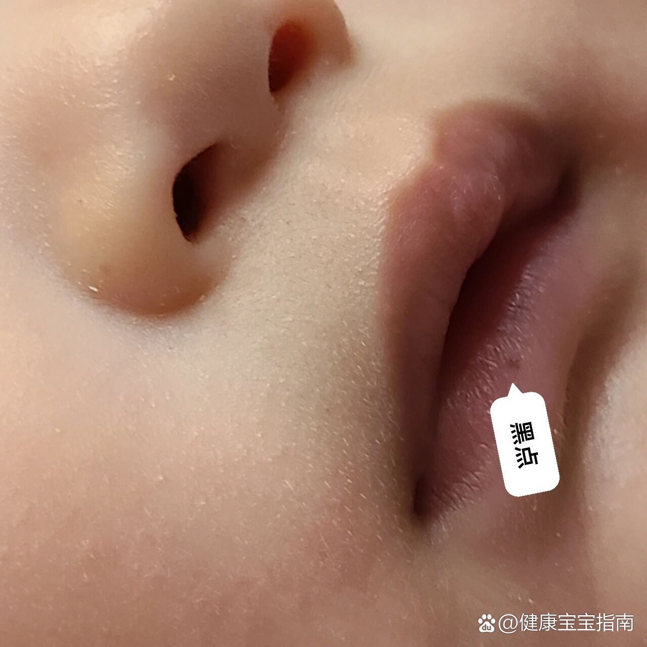  p>婴儿唇部长黑点黑痣 br>宝宝六个多大,突然唇部长了一个小黑点,有