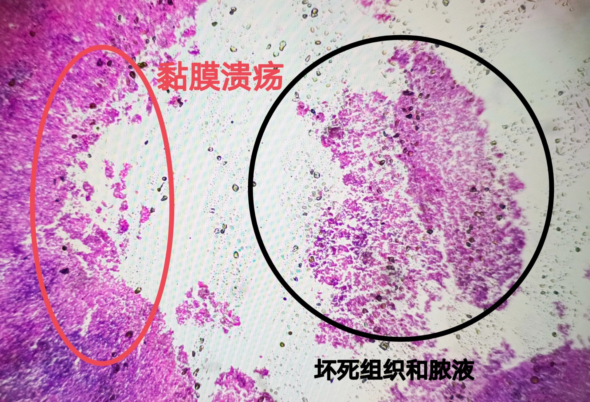 阑尾炎病理生理图图片