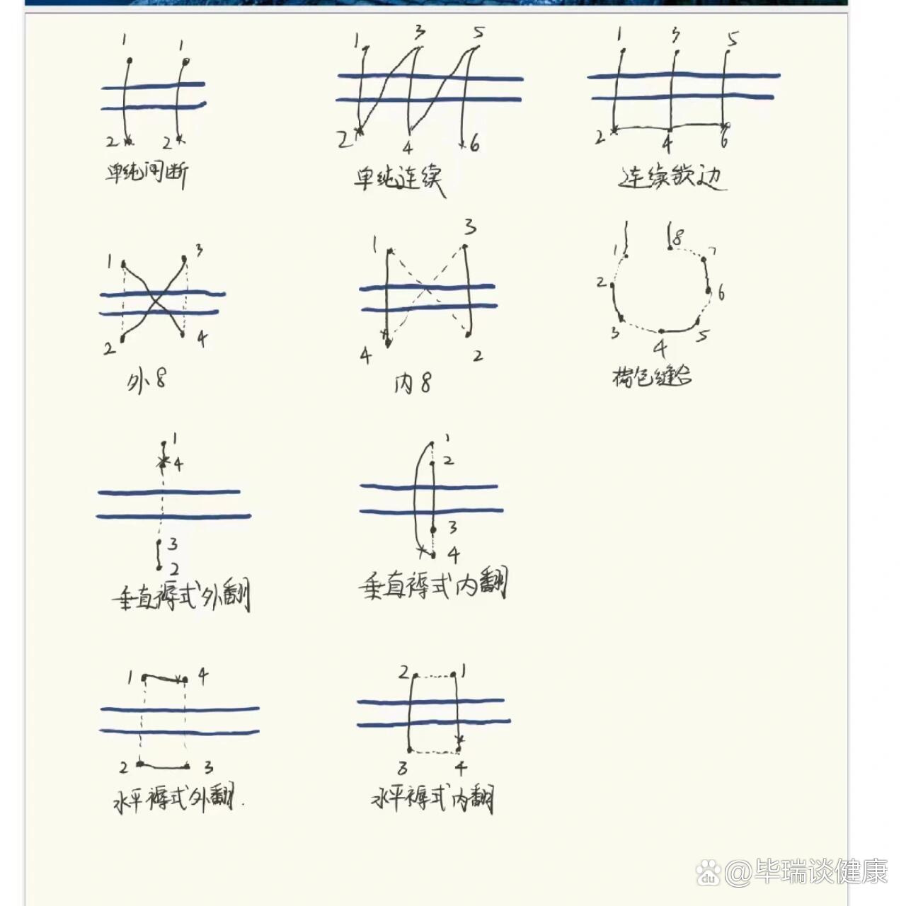 褥式缝合图解图片