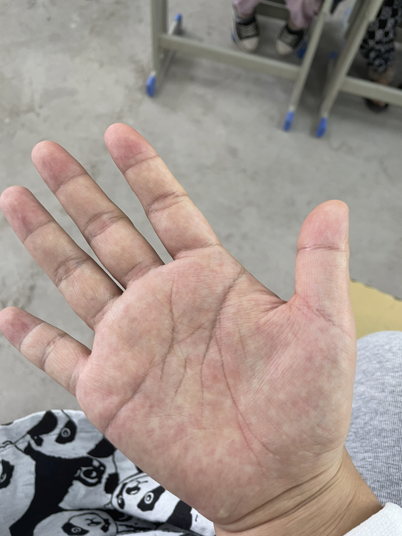 手掌红点,指甲发红