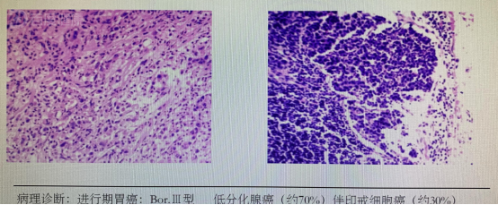 印戒细胞癌原因有多种-医疗科普-百度健康