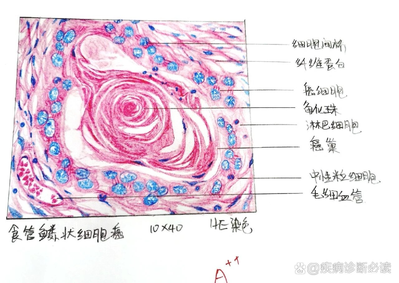 肿瘤终于完成了家人们家人们,我发现了一个超级好看的红蓝手绘图