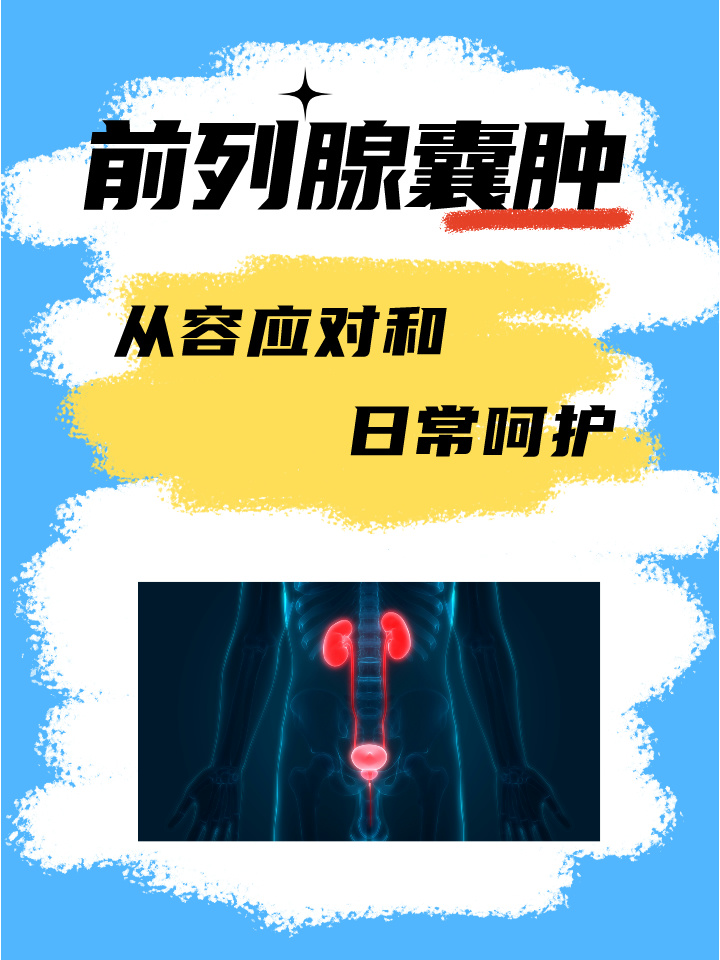 前列腺囊肿:从容应对的秘诀与日常呵护
