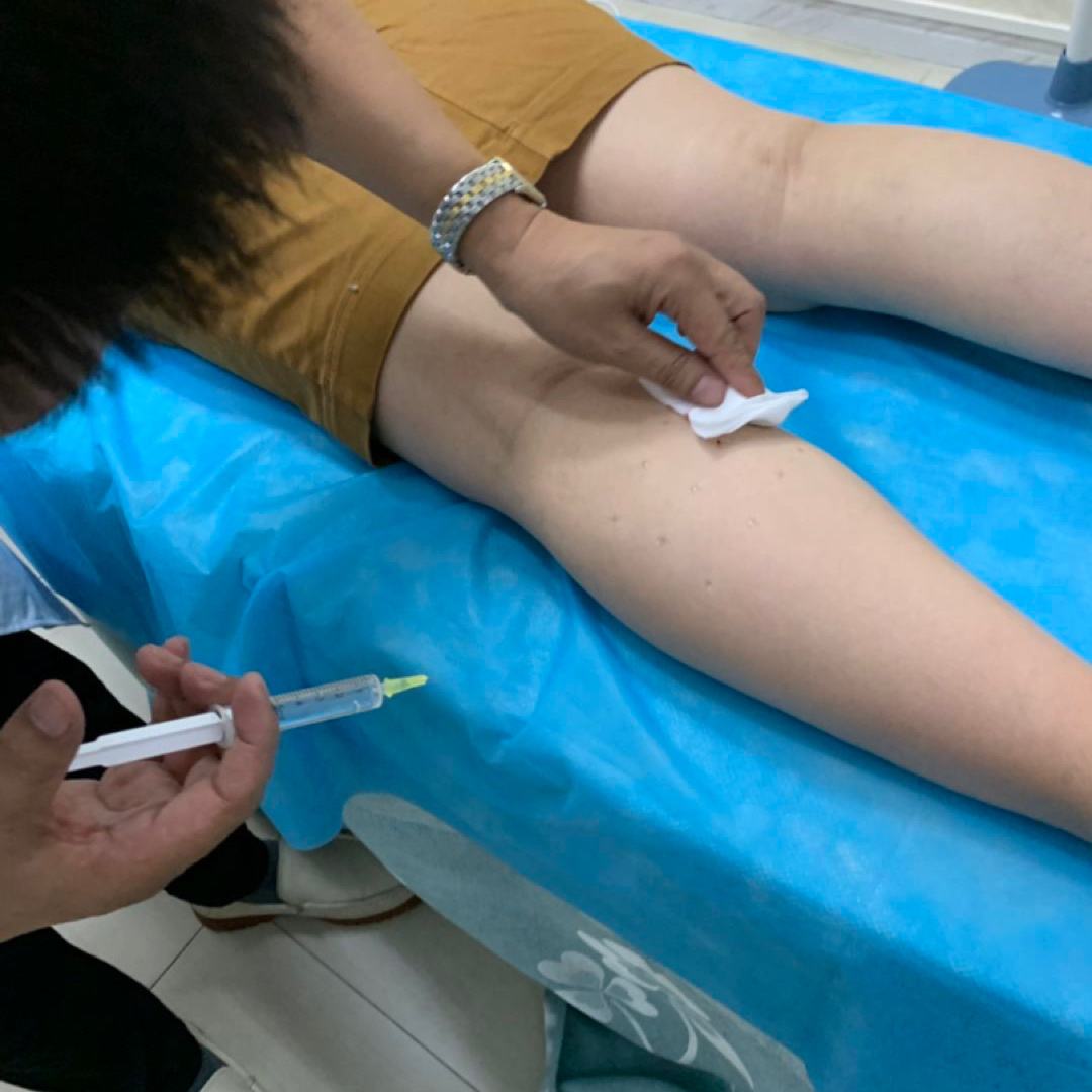 打瘦腿针需要技术吗_打瘦腿针需要绷紧肌肉吗_瘦腿针需要打几针