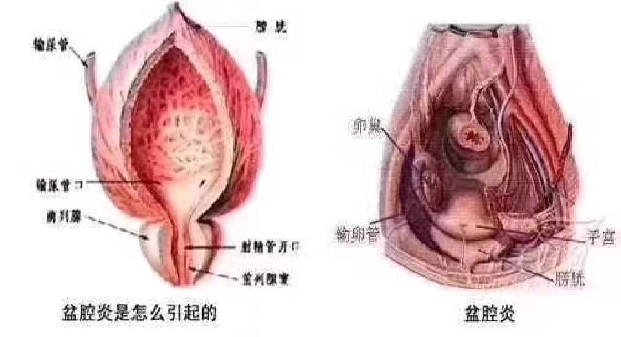 图片什么是盆腔积液7515