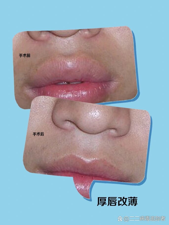93厚唇改薄