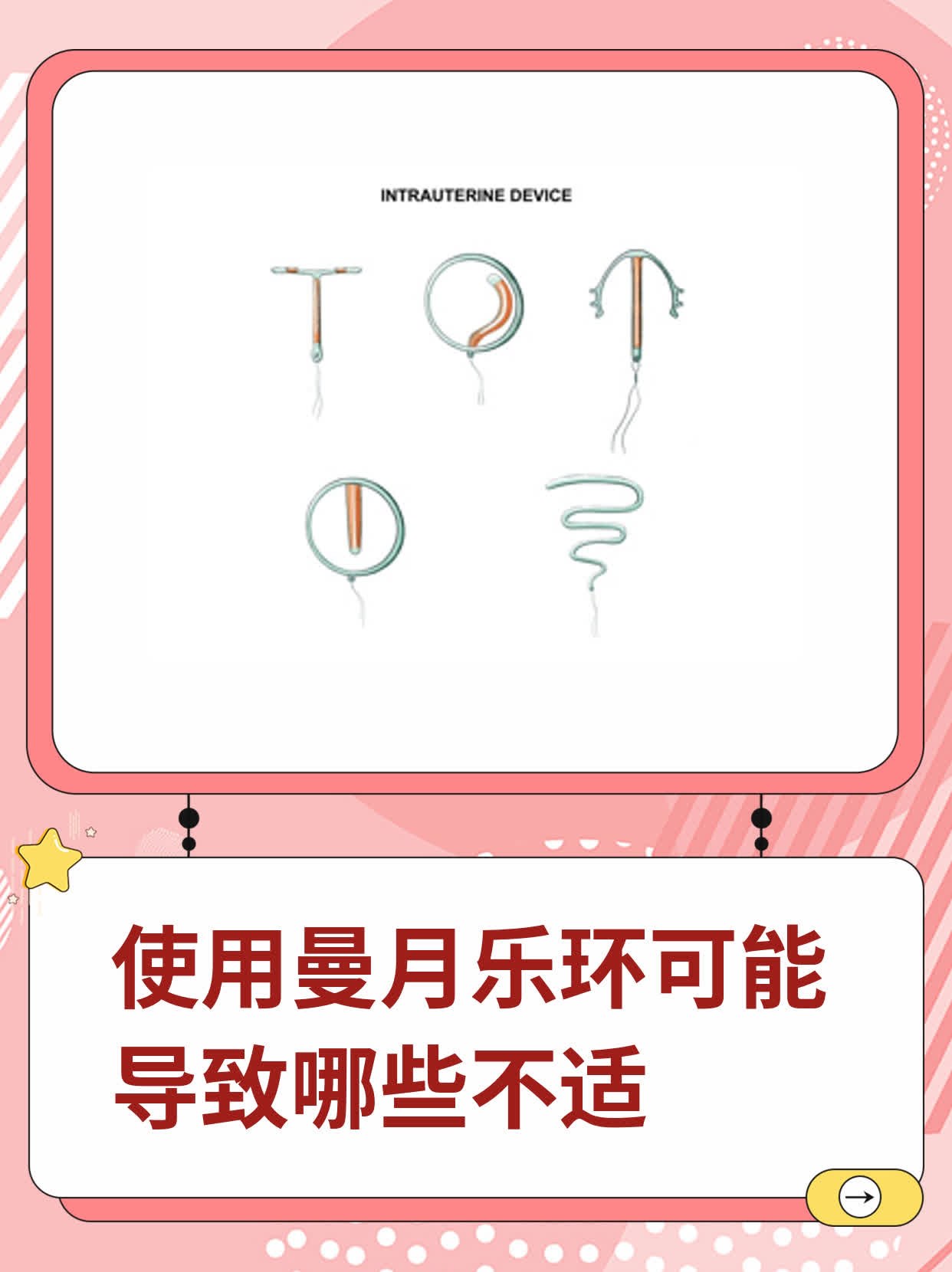 使用曼月乐环可能导致哪些不适
