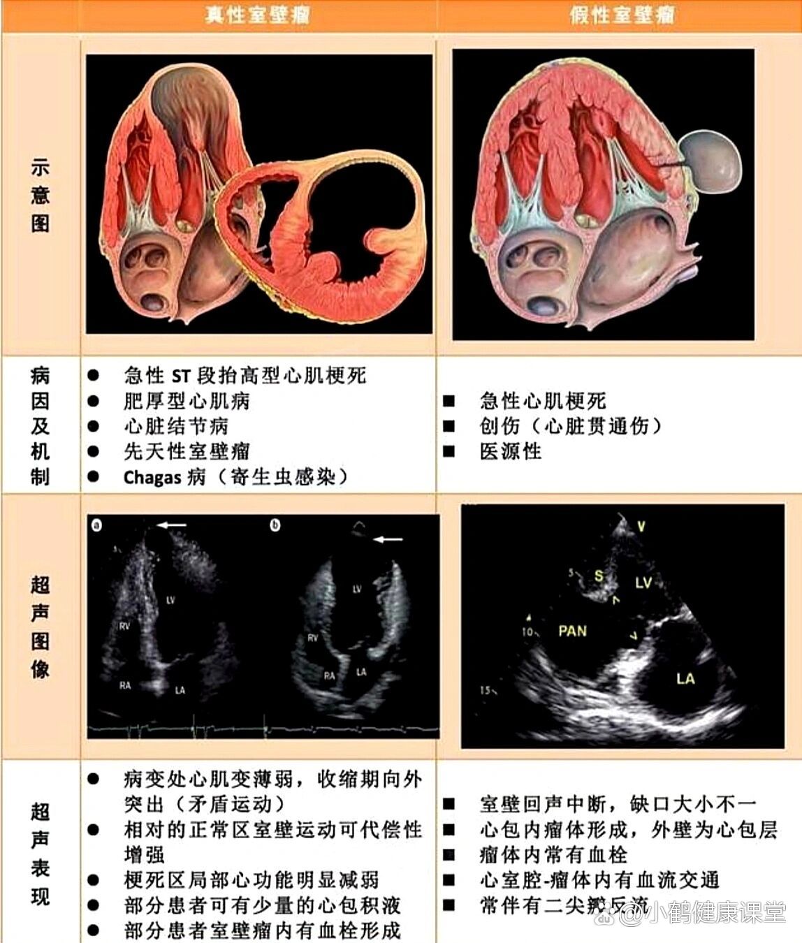 室壁瘤的临床机制和思维