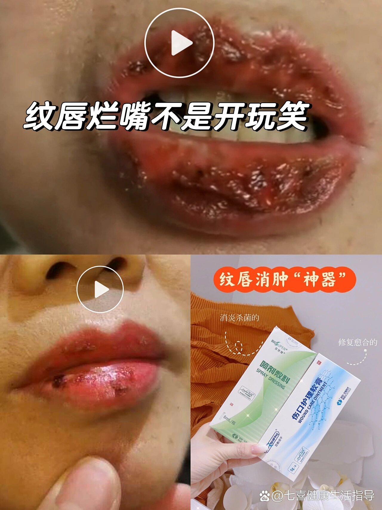 纹唇后嘴巴都烂了,涂两天"神器"好了