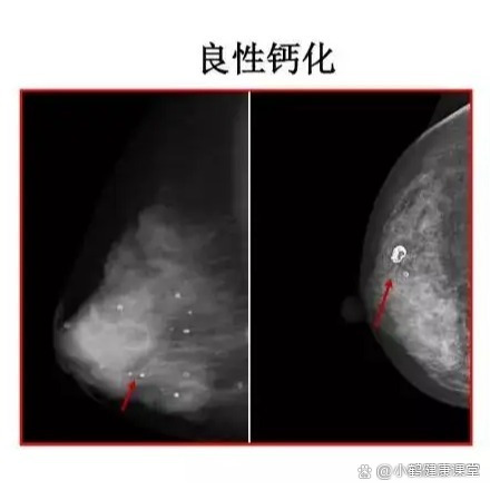 乳腺点状钙化图片