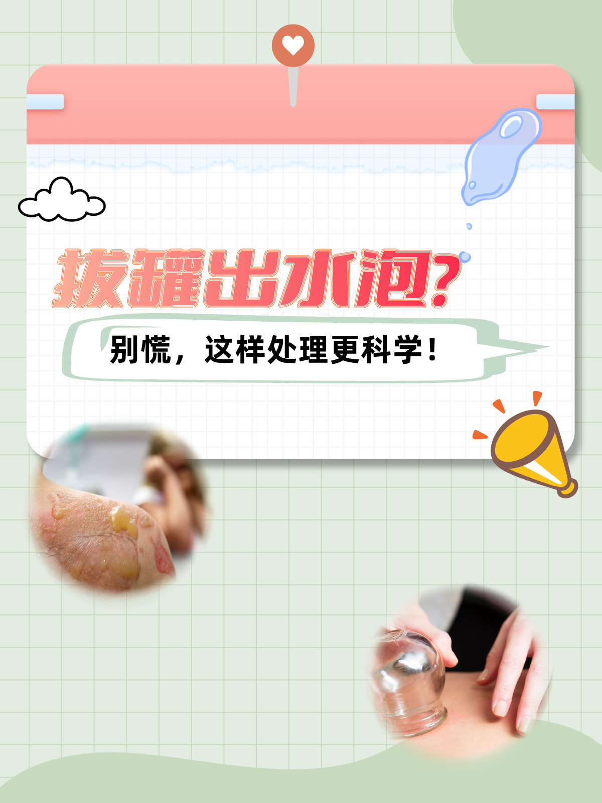拔罐出水泡?别慌,这样处理更科学!