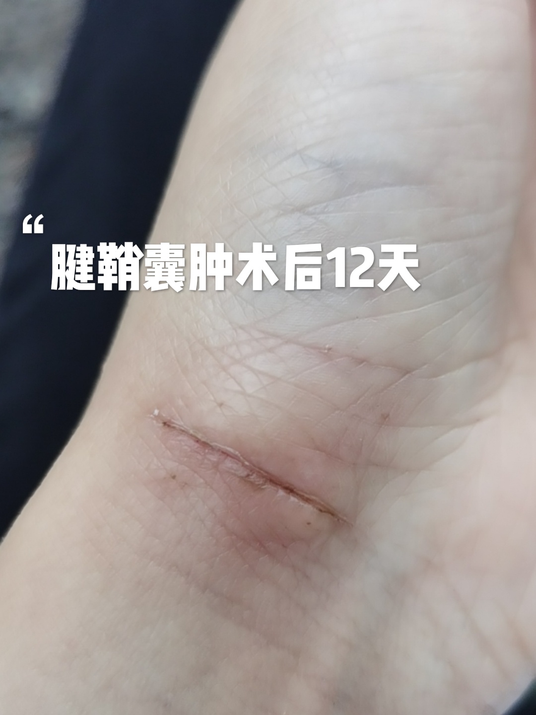 腱鞘囊肿术后恢复