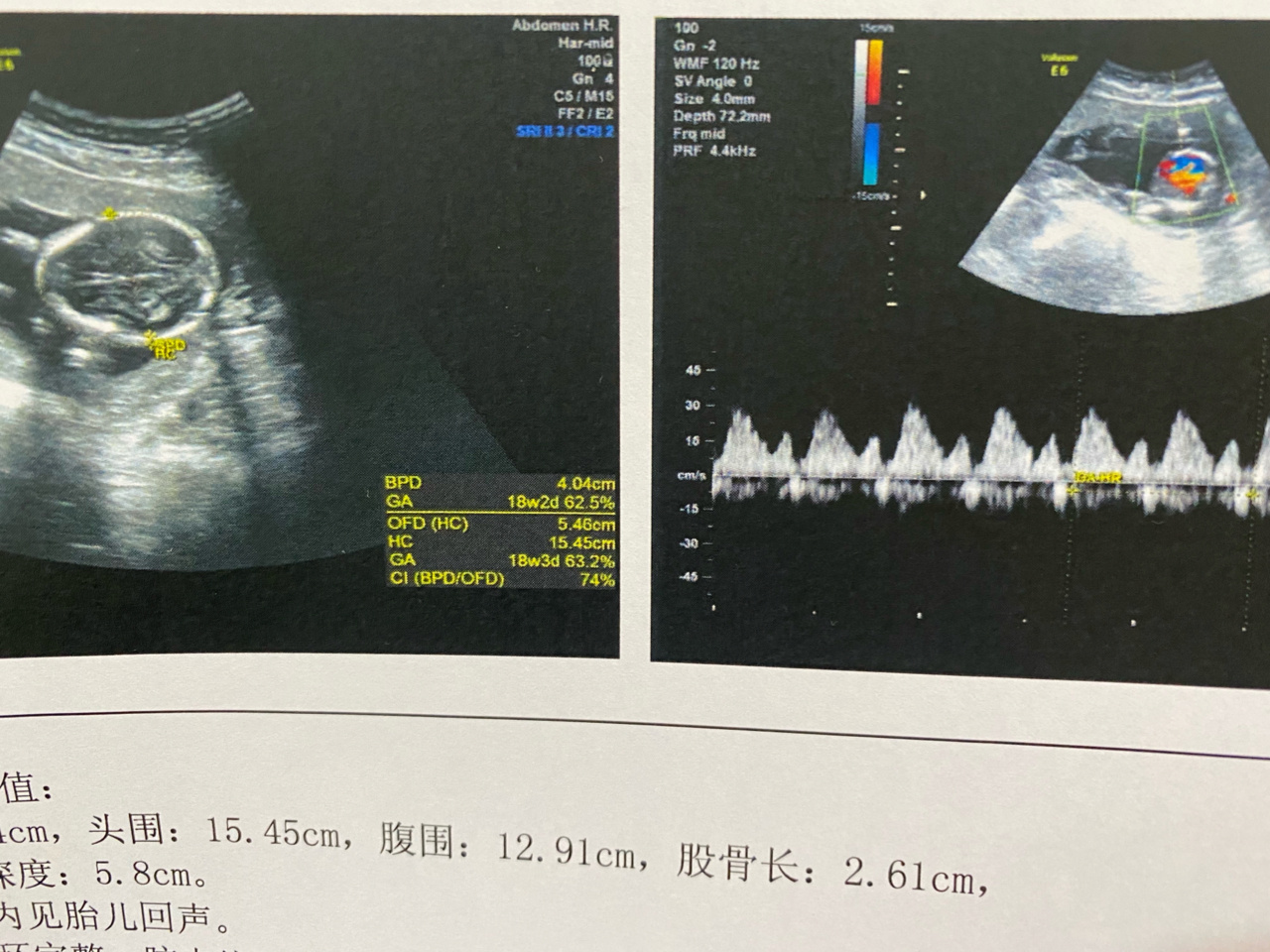 孕18周小孕期彩超03