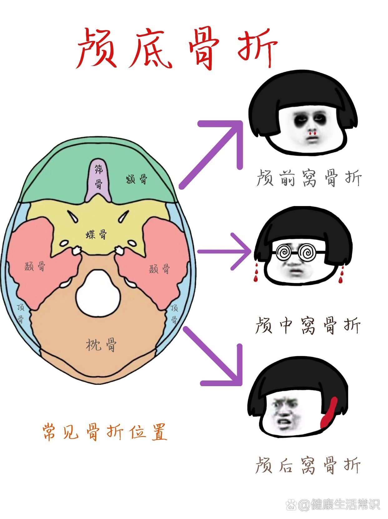 熊猫眼颅底骨折图片图片