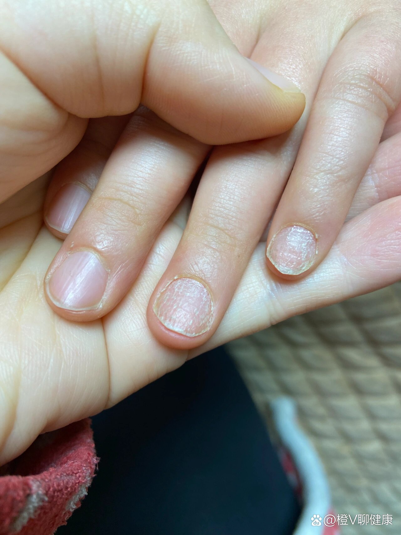 六岁或者更早就有两个指甲是这样子,看起来皱巴巴的,也不软,去医院