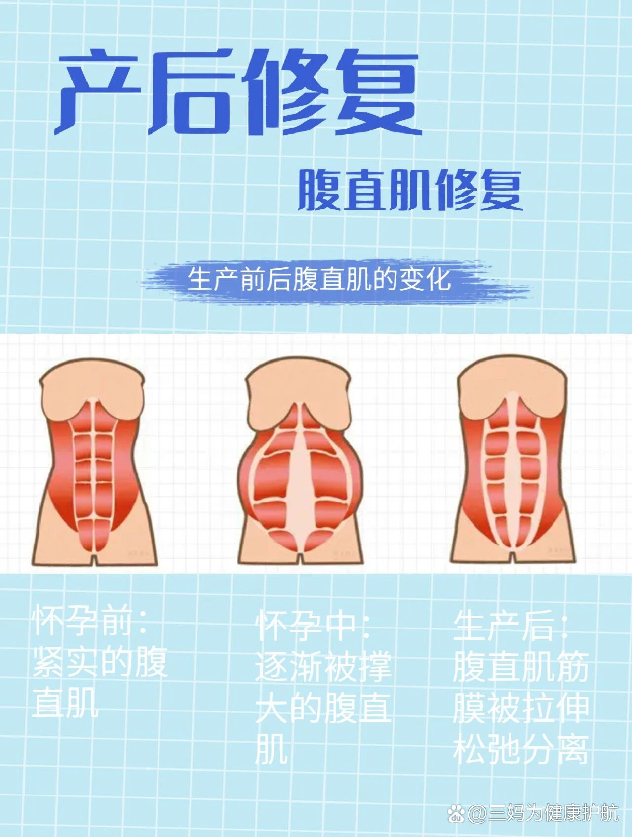 🔥产后腹直肌修复的必要性㊙️