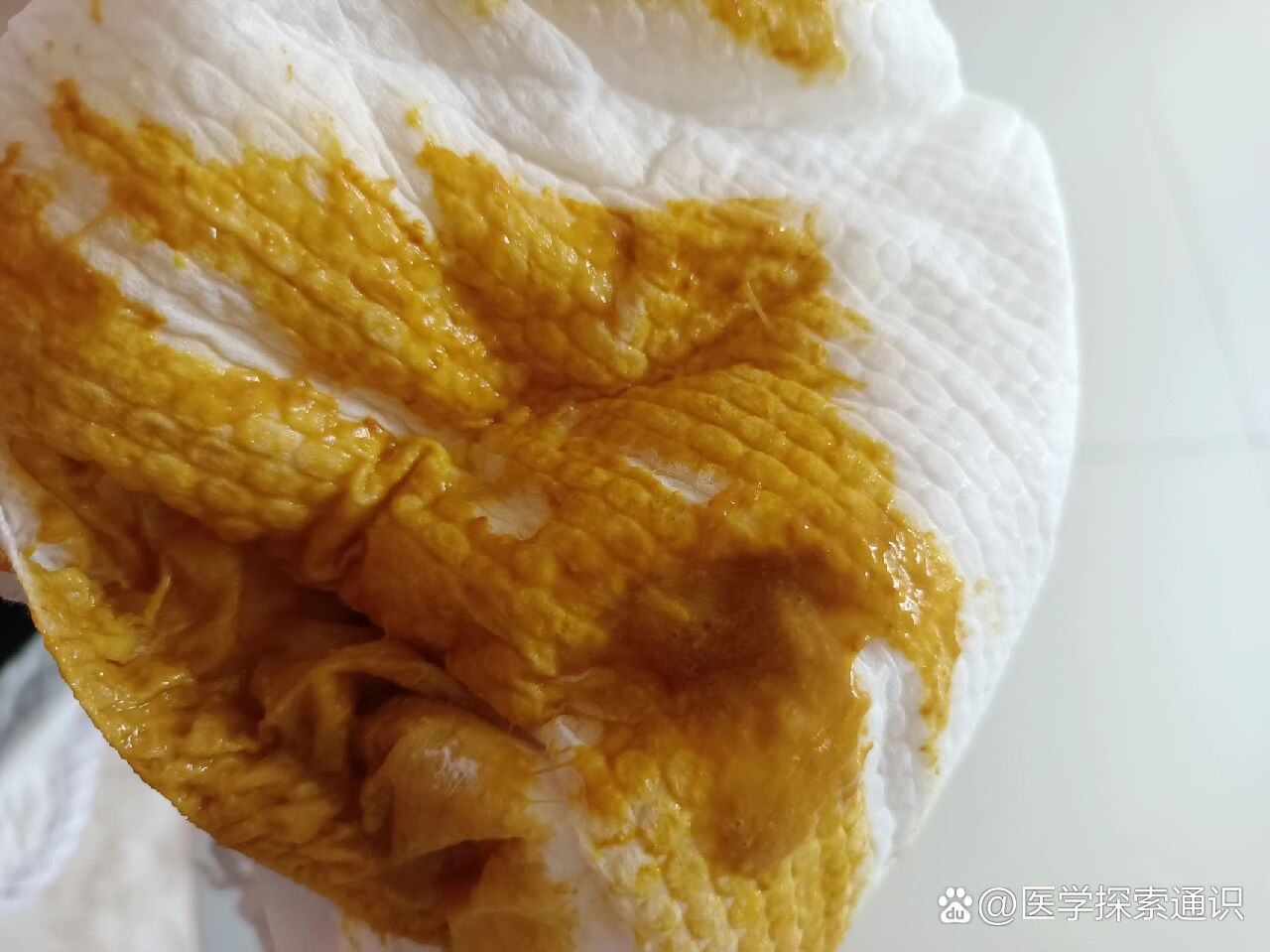 牛奶蛋白过敏拉血丝粘液两次(有便便图)