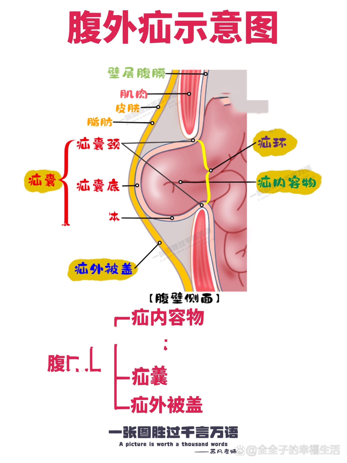 腹股沟斜疝和直疝图解图片