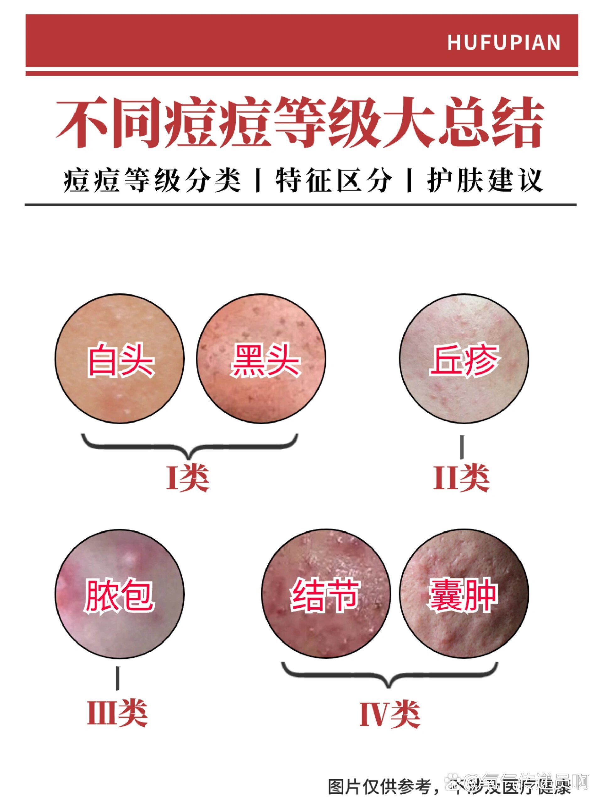 粉刺和痘痘怎么区分图片