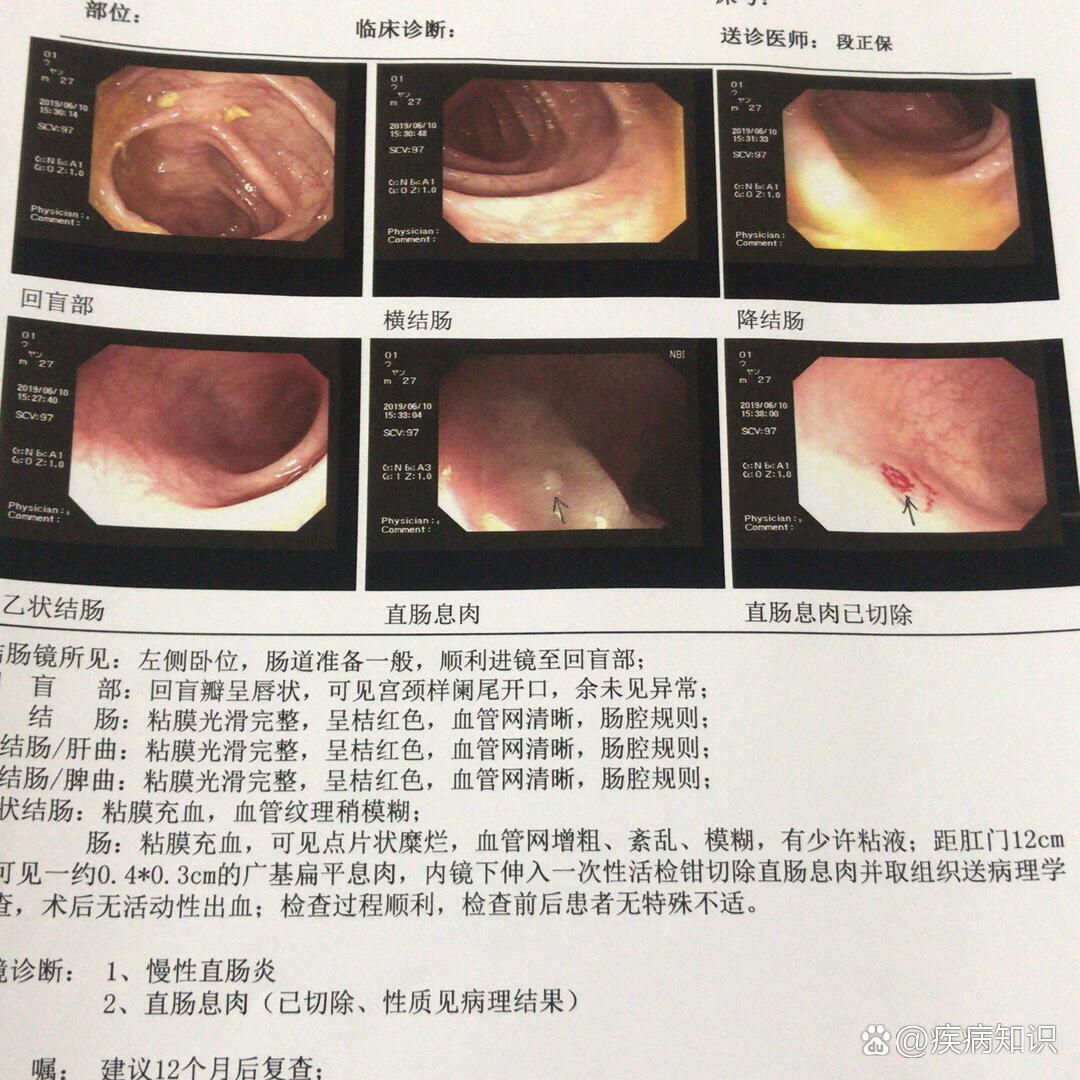 建议如果特怕痛的就做无痛肠镜