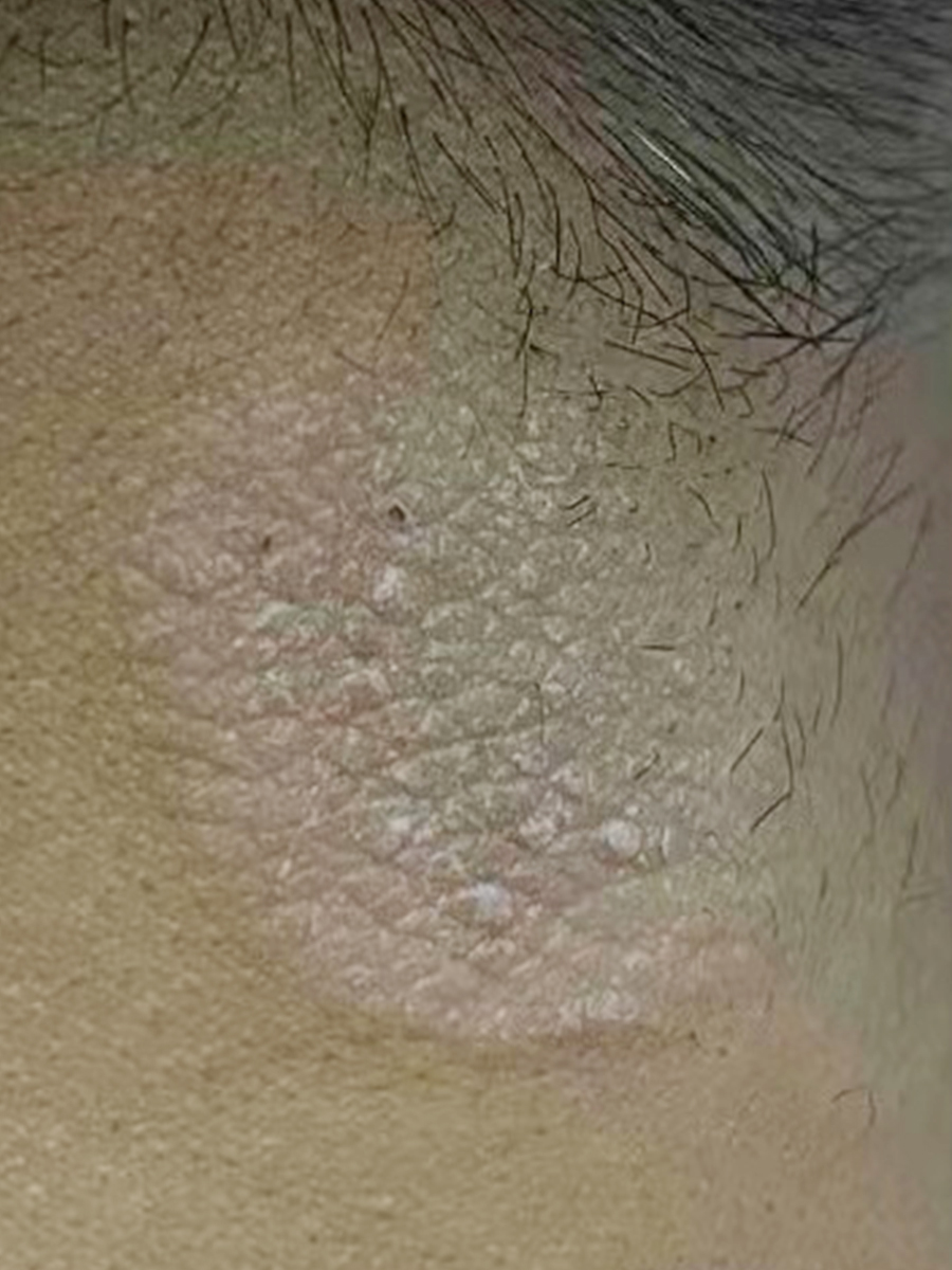 23岁男性患皮肤角化病,药物治疗后病情好转