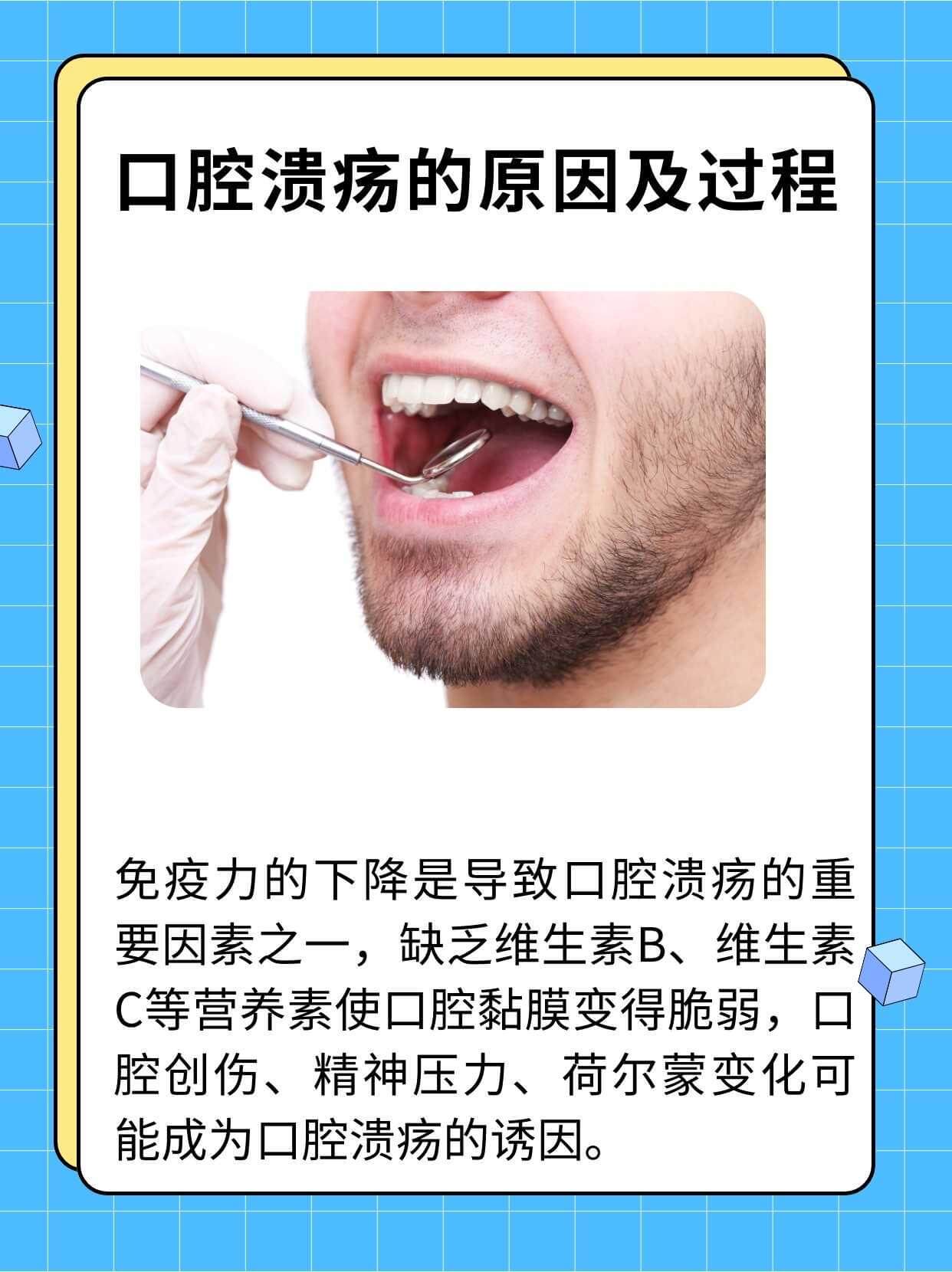 口腔溃疡的成因与发展过程