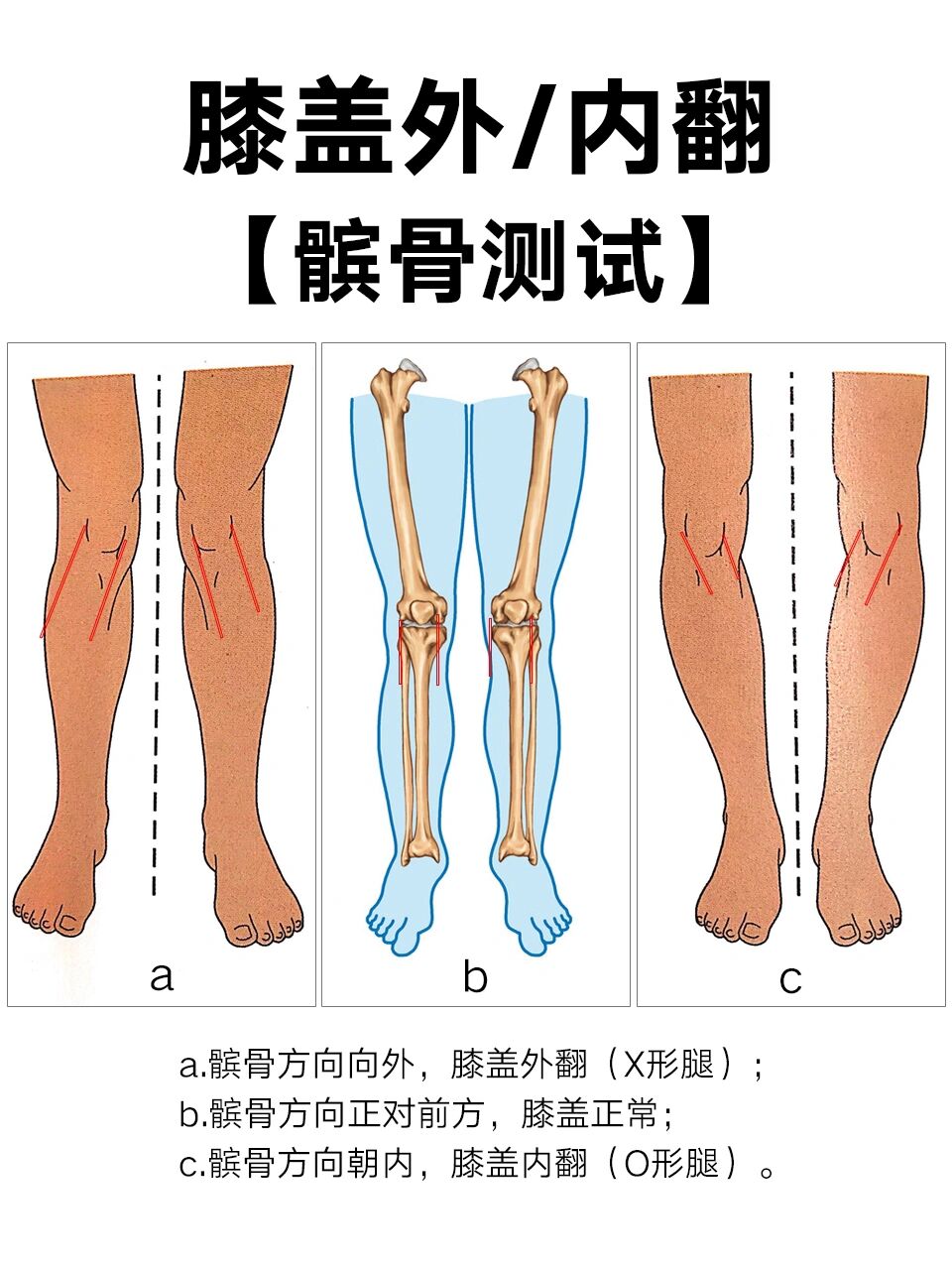 膝盖内旋小腿外翻图图片