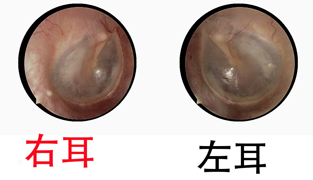 耳膜正常图片