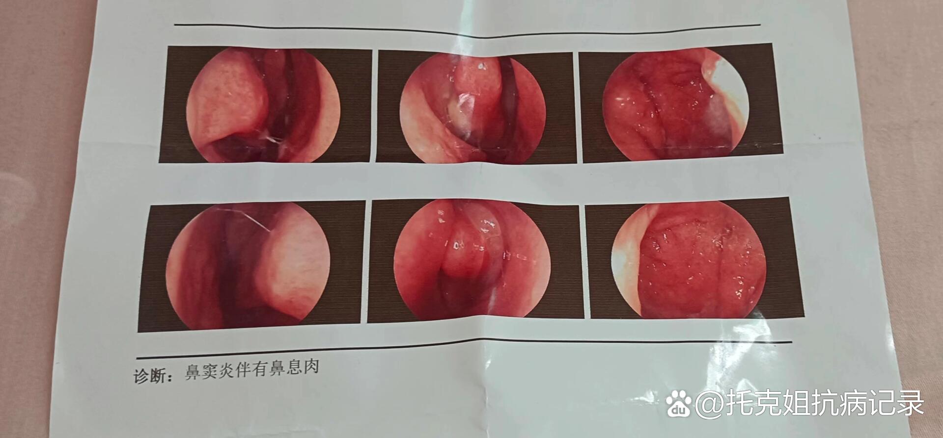 我的鼻炎治疗心得