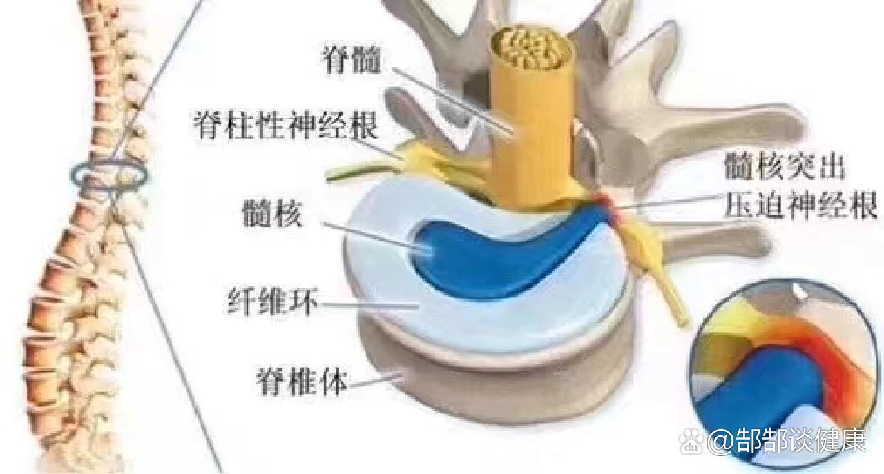 腰椎硬膜囊及神经根受压