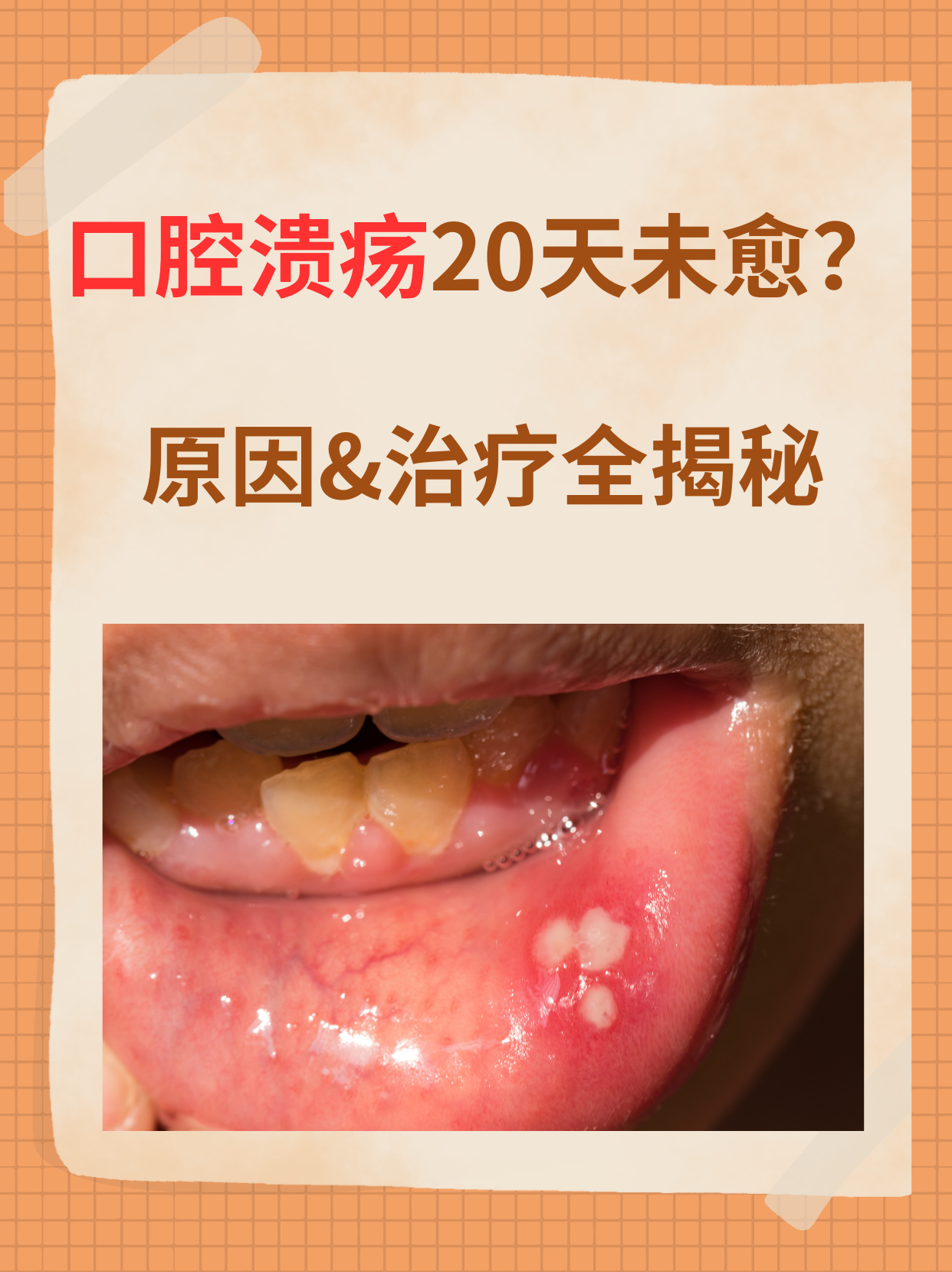 口腔溃疡20天未愈?原因&治疗全揭秘