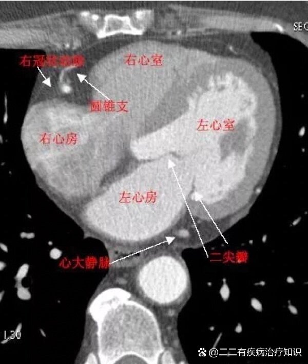 02心脏ct解剖图