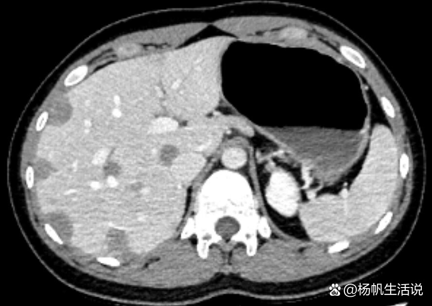 肝脏上皮样血管内皮瘤影像表现