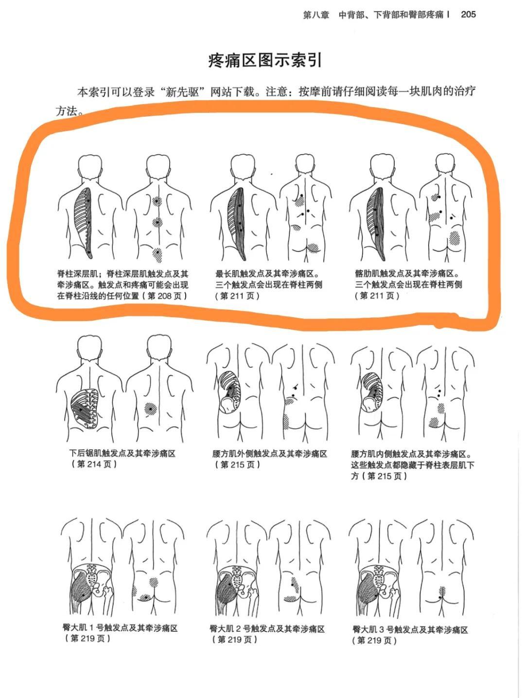 背痛原因及解决方法：肌筋膜触发点详解