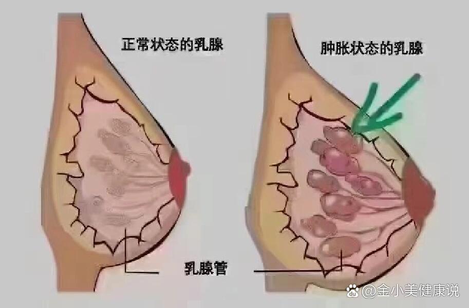 直到下一次涨奶时刺痛才会减轻,而且只有一侧乳房感到刺痛,针扎的位置