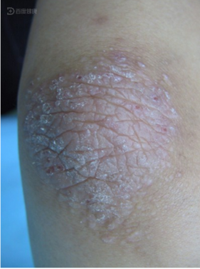 最近几个月他发现自己的双侧胳膊肘各长了一块"癣",非常痒,尤其到了