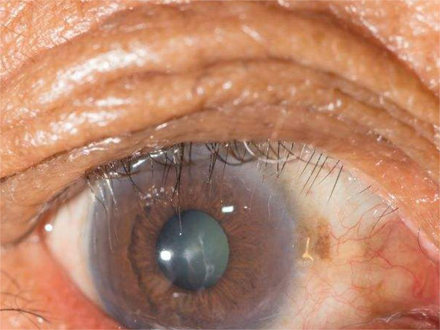 67岁孙女士玻璃体混浊,导致眼前黑影飘动!