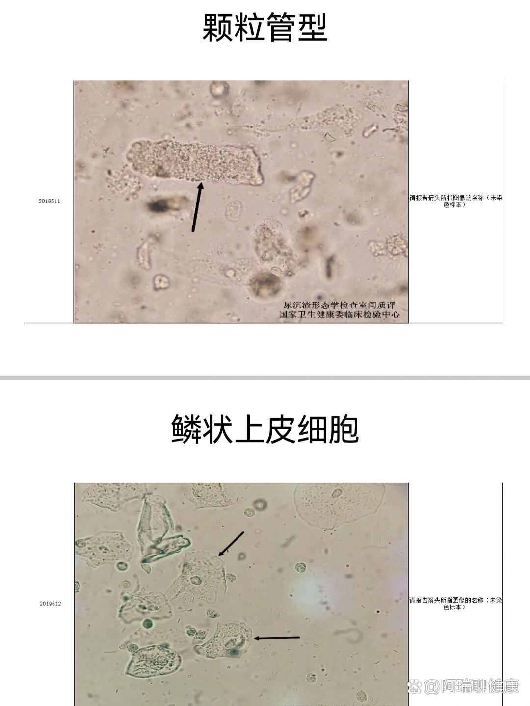 尿沉渣图谱结晶图片