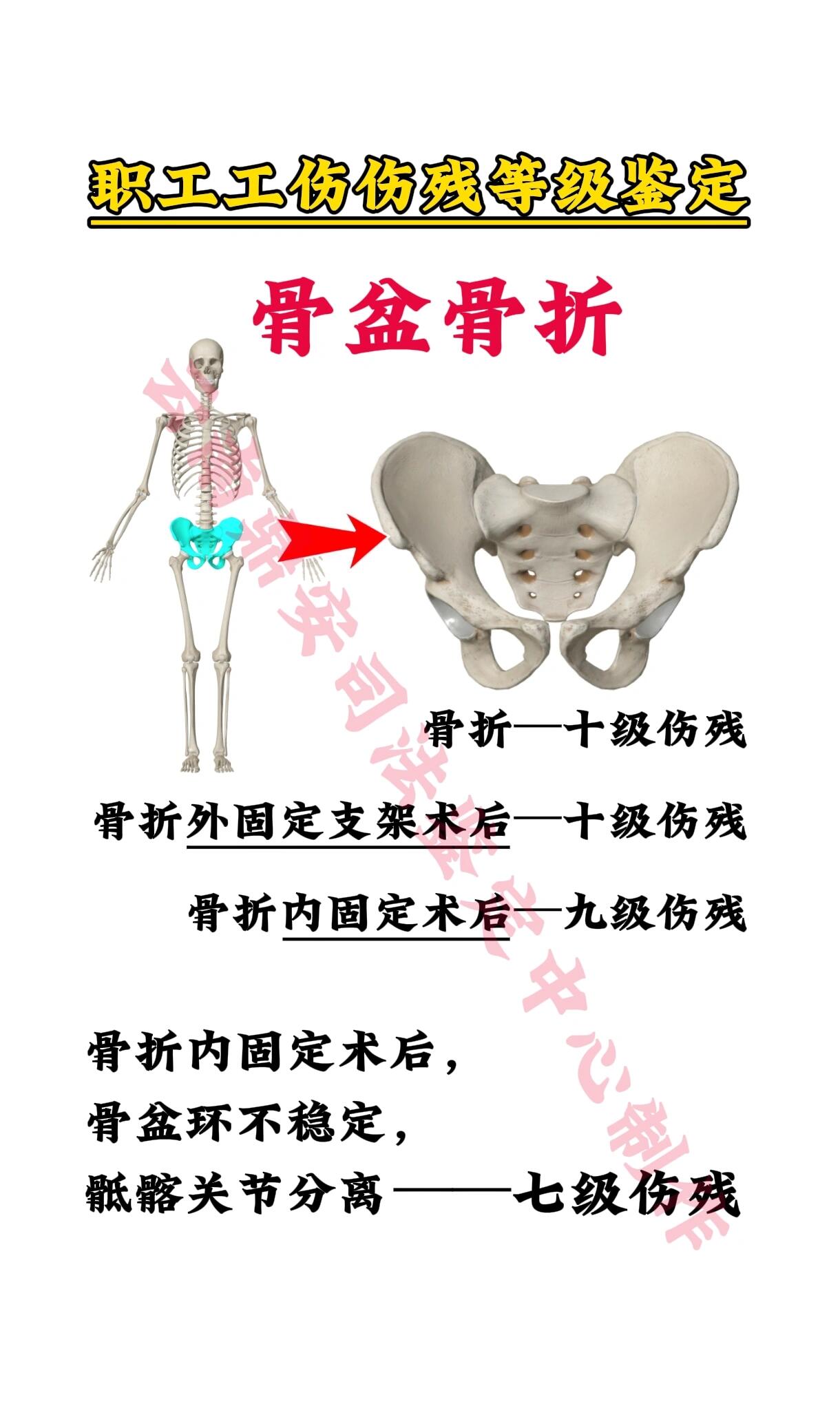 职工工伤骨盆骨折伤残等级一览表