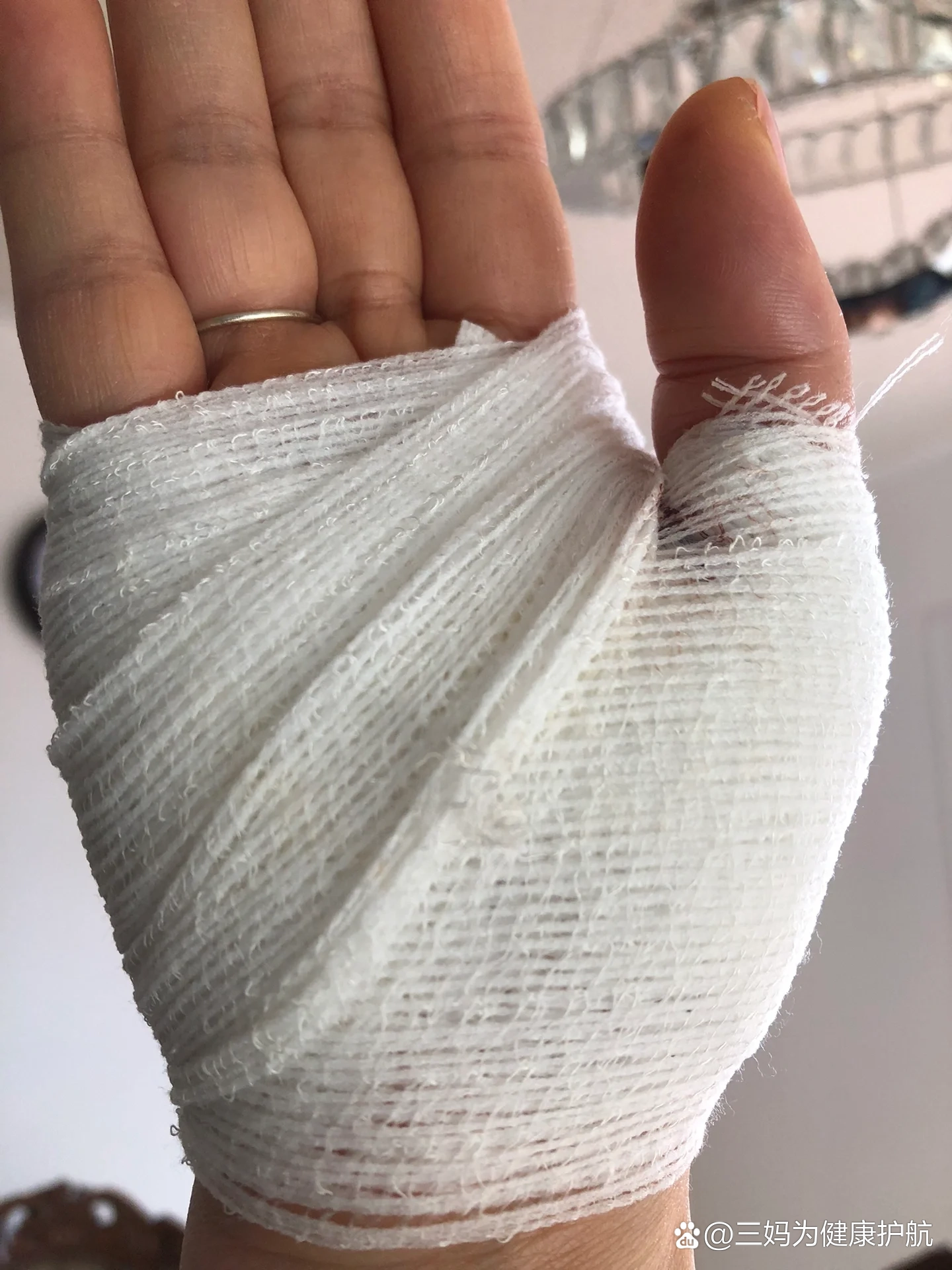 以上就是本人昨天上午亲身经历被玻璃割伤大出血的事件,去社区医院缝