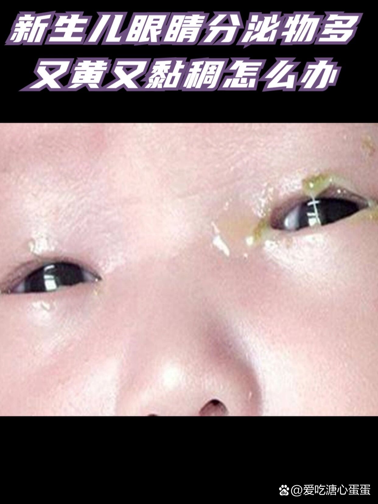 建议带新生儿去眼科就诊,通过相关检查明确是否有眼部感染,泪道阻塞