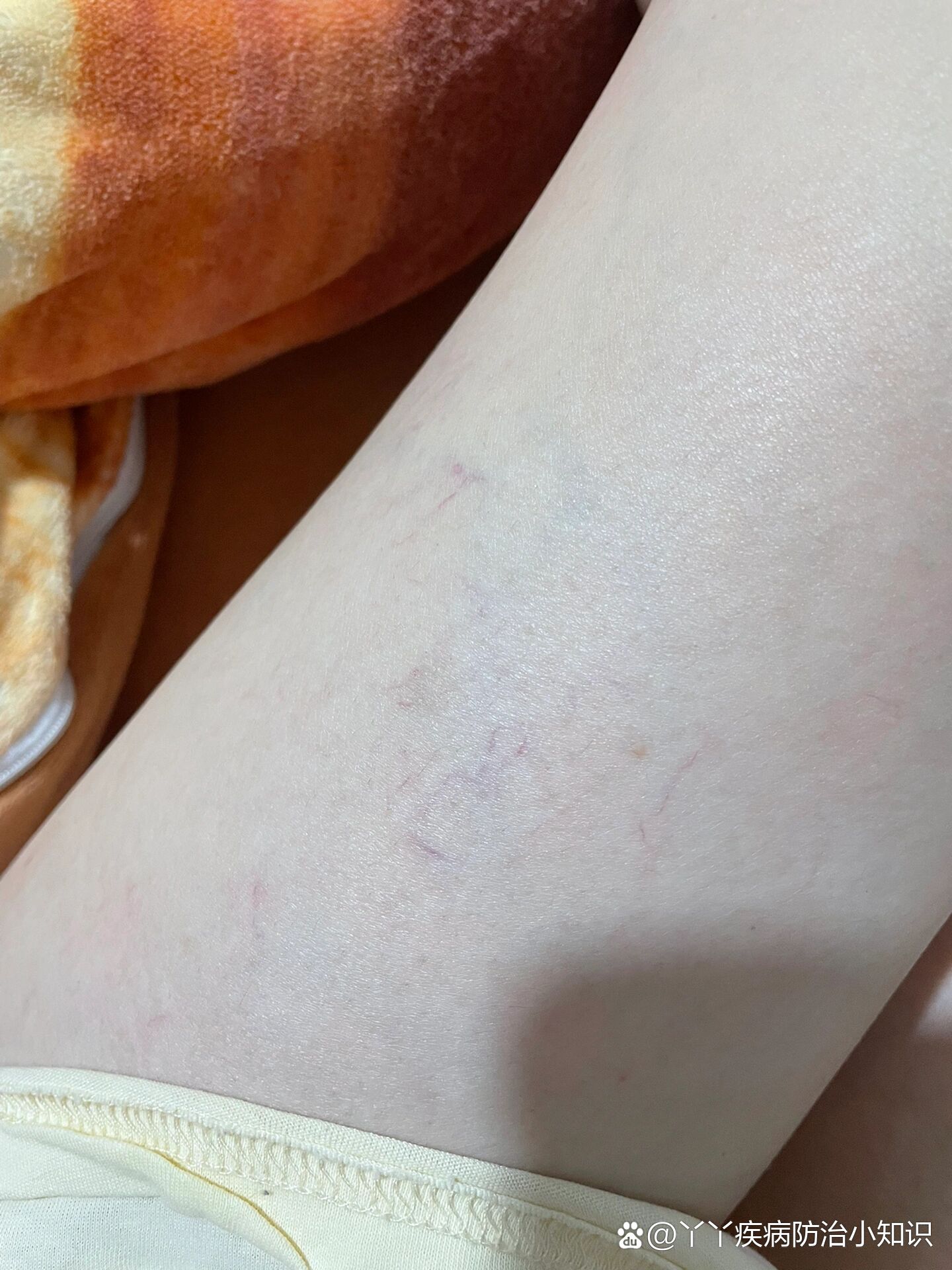 腿上突然出现了很多红血丝