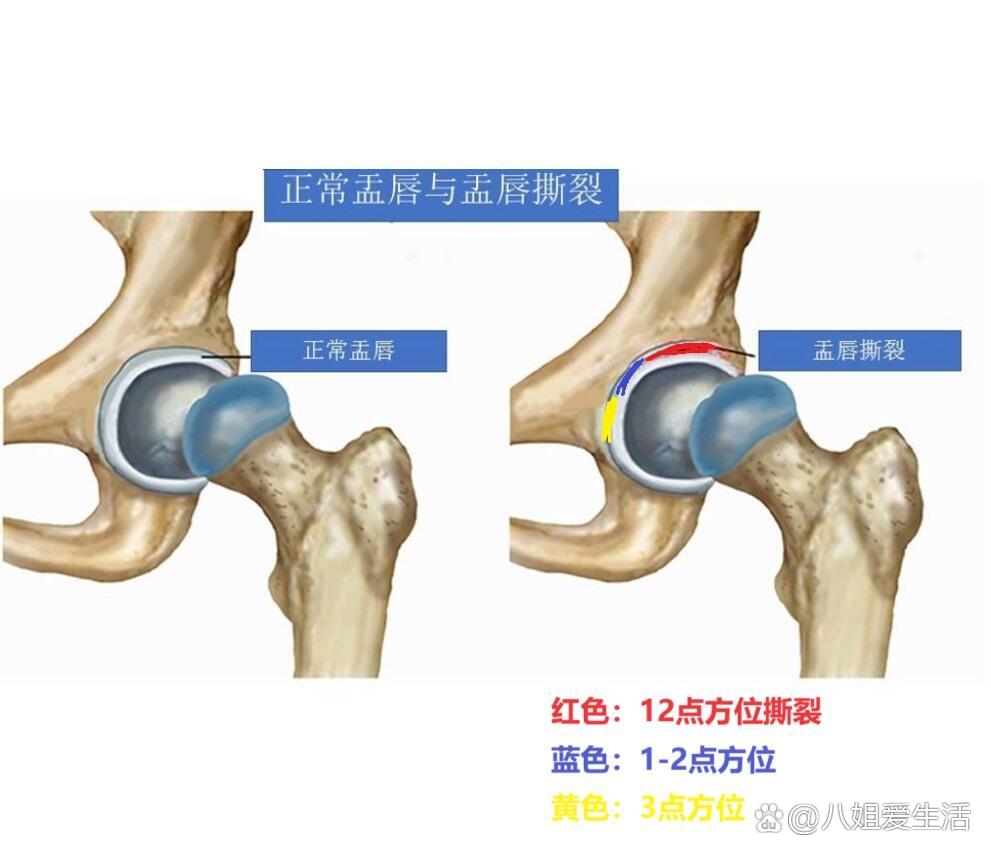 知识 | 你们要的由远至近的髋盂唇,全不全图一:盂唇在髋关节内