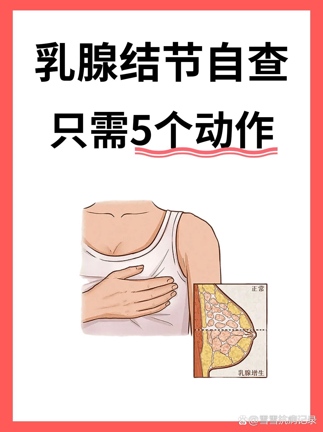 乳腺结节5步自查73告诉你乳腺增生最怕3食物