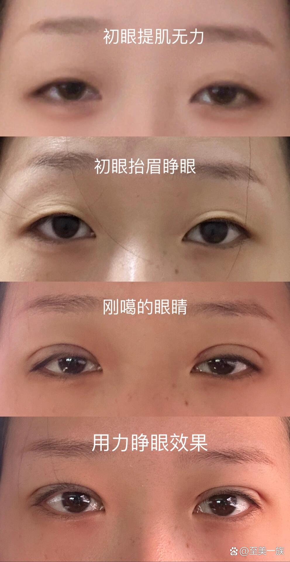 提肌无力噶双眼皮第一天
