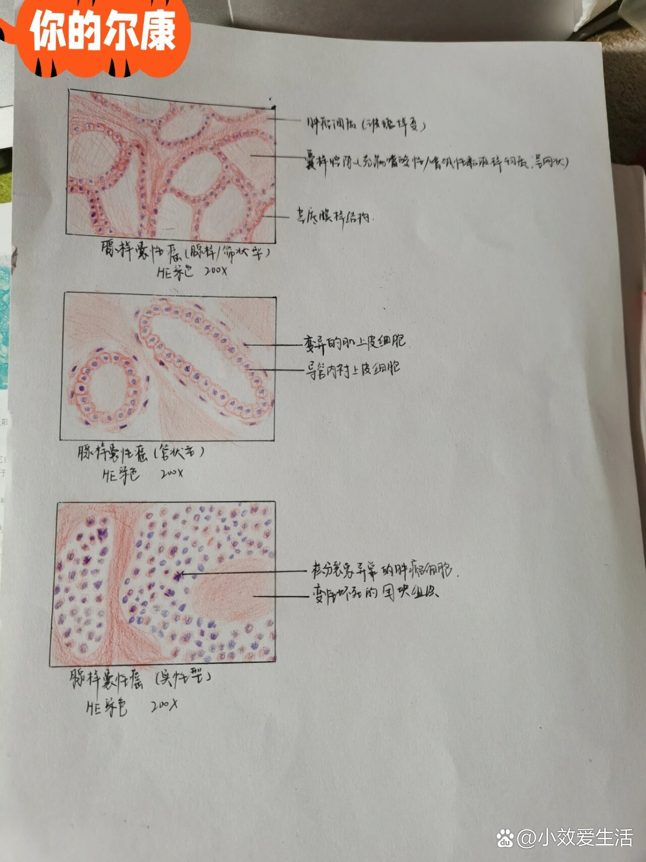 腺样囊性癌绘图